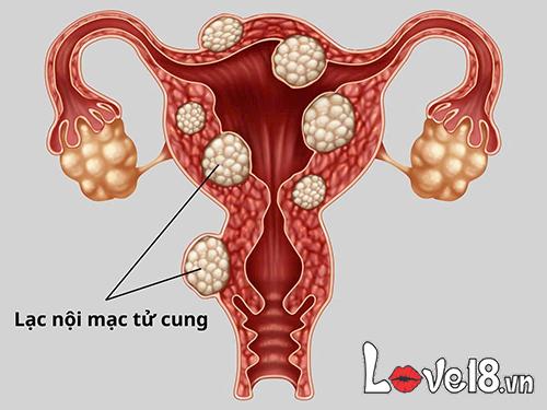 Quan hệ ngày đèn đỏ có bị vô sinh không? Nguy cơ cần biết 5 quan hệ ngày đèn đỏ có bị vô sinh không? nguy cơ viêm nhiễm