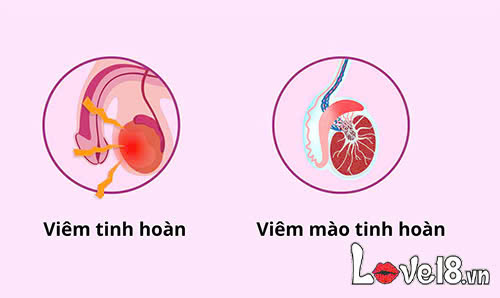 Tinh trùng màu gì thì bị vô sinh? Bác sĩ giải đáp 4 Tinh trùng màu gì thì bị vô sinh? Nguyên nhân đổi màu