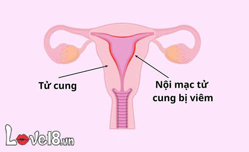 Viêm bộ phận sinh dục nữ là gì? Nguyên nhân và cách điều trị 4 viêm bộ phận sinh dục nữ là gì? viêm tử cung