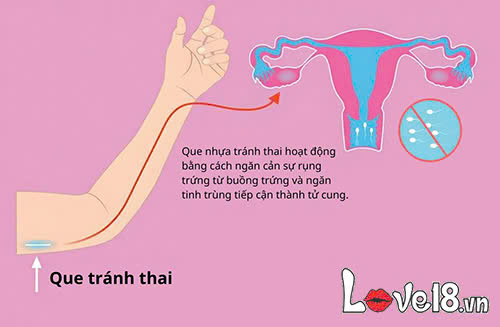 Cấy que tránh thai bao lâu thì có tác dụng? Bác sĩ giải đáp 2 Cấy que tránh thai bao lâu thì có tác dụng? Cơ chế hoạt động