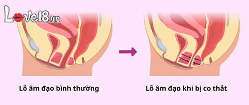 Phụ nữ lâu ngày không quan hệ vùng kín có khít lại không? 4 Lâu ngày không quan hệ vùng kín có khít lại không? nguyên nhân