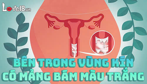Bên trong vùng kín có mảng bám màu trắng