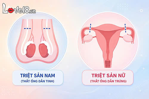 Triệt sản nam hay nữ thì tốt hơn? So sánh từng phương pháp 2 phương pháp triệt sản nam hay nữ thì tốt hơn