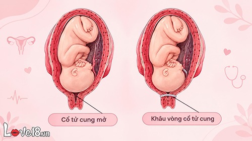 Khâu eo cổ tử cung có quan hệ được không? Lời khuyên bác sĩ 2 thai phục khâu eo cổ tử cung có quan hệ được không